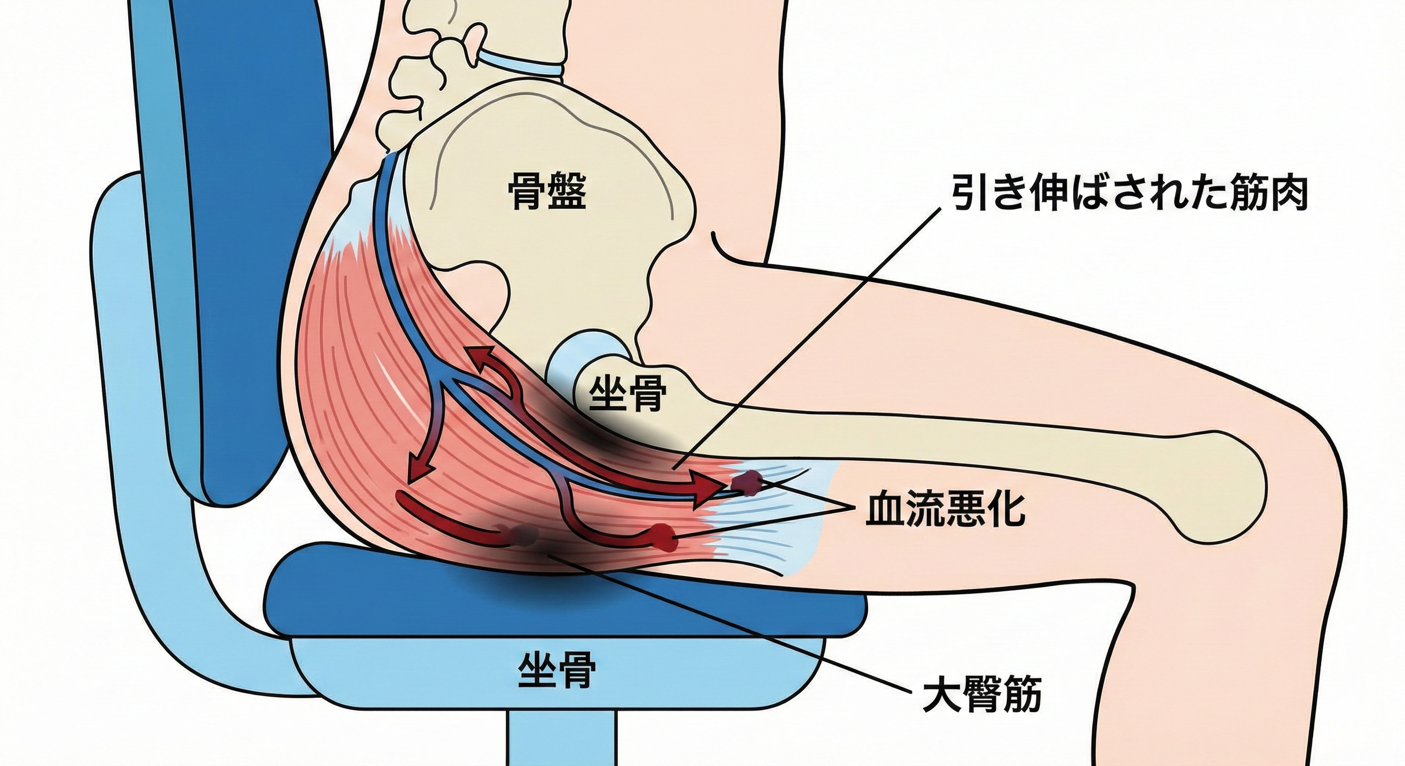 座り姿勢でお尻の筋肉が引き伸ばされ血流が悪化している図解