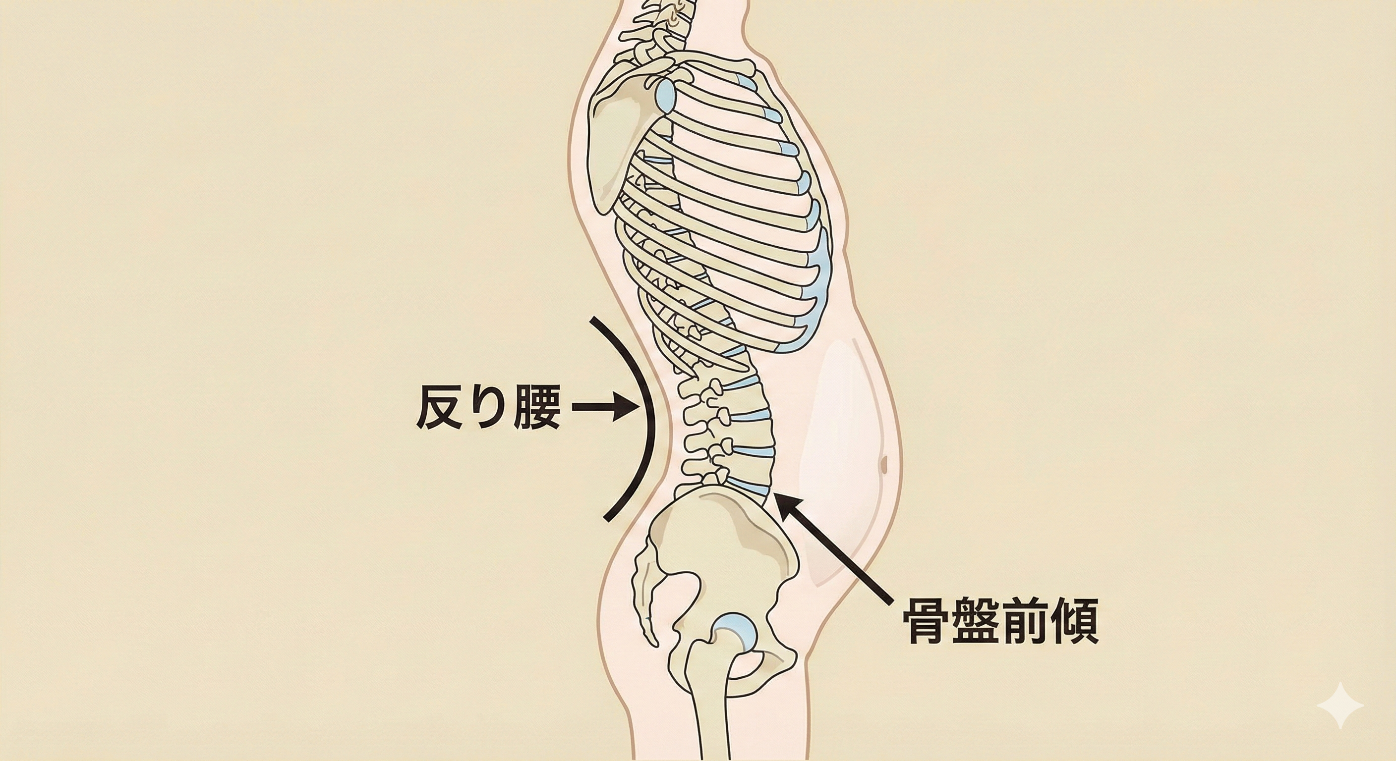 反り腰の状態でお腹が突き出ている骨格図