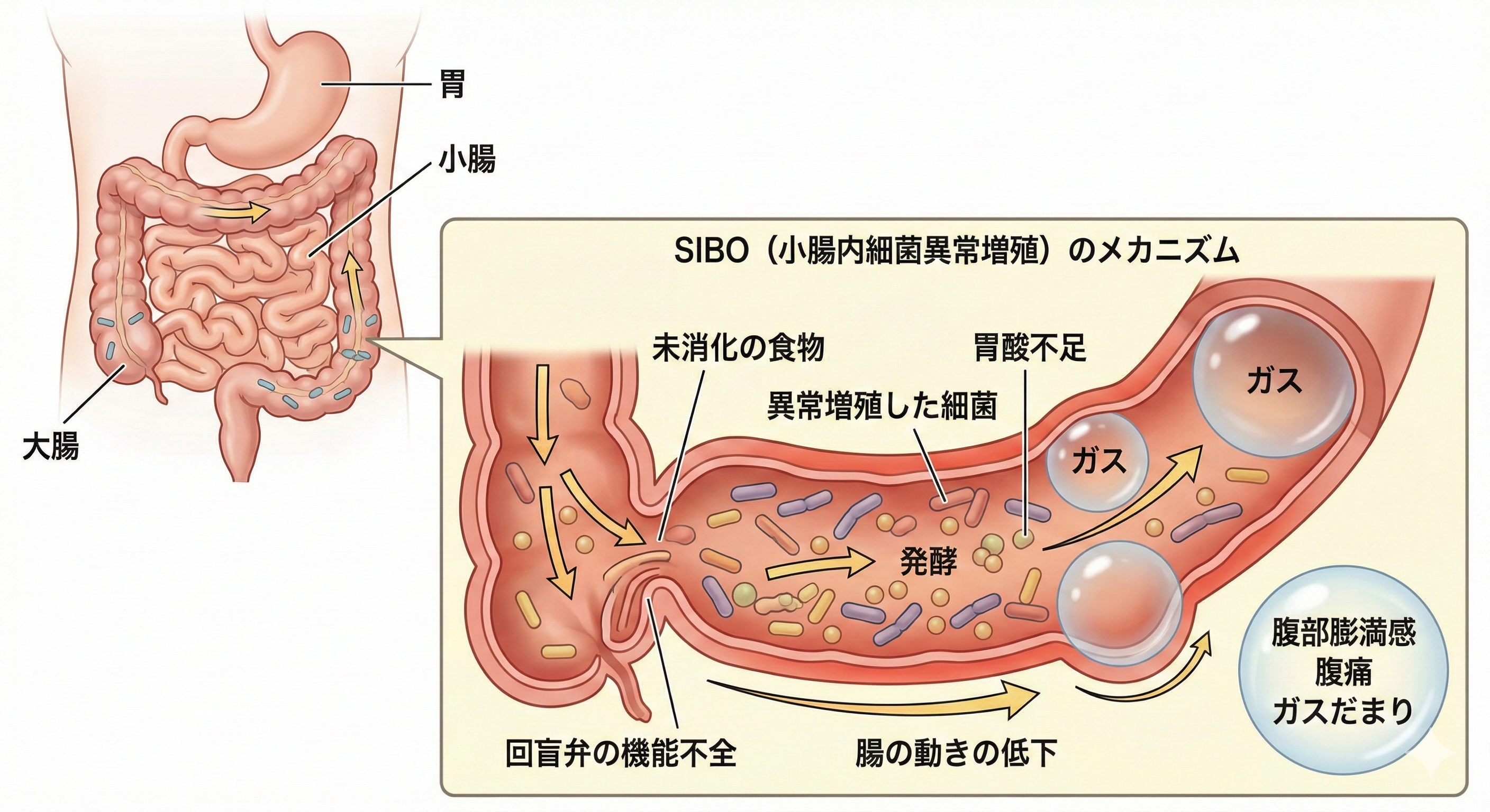 小腸で細菌が増殖し、ガスが発生しているSIBOのメカニズム図